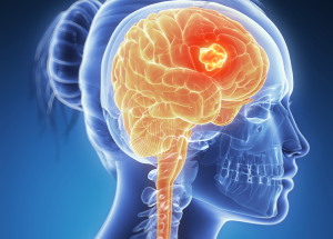 Brain Tumor-nitin-jagdhane-neurology-mumbai
